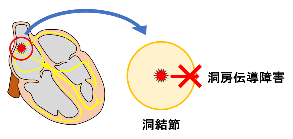 洞房ブロック(sinoatrial block)