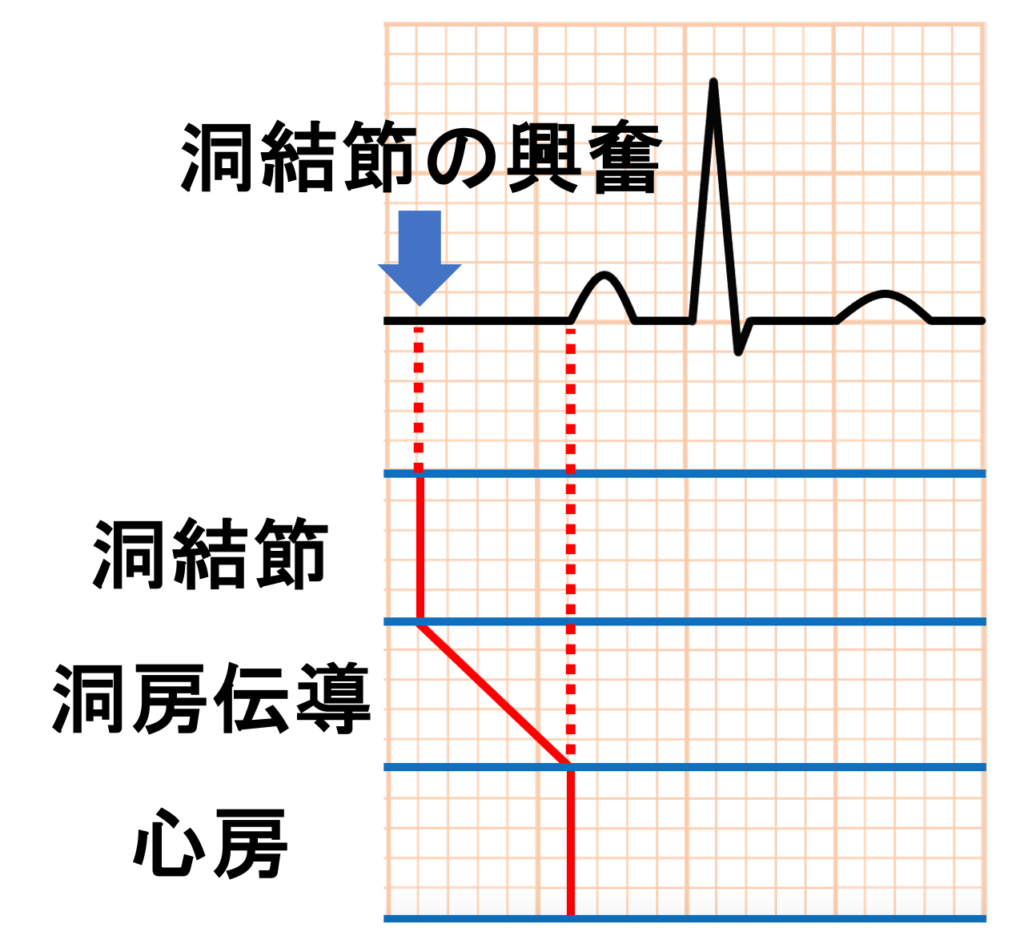 洞房ブロック(sinoatrial block)