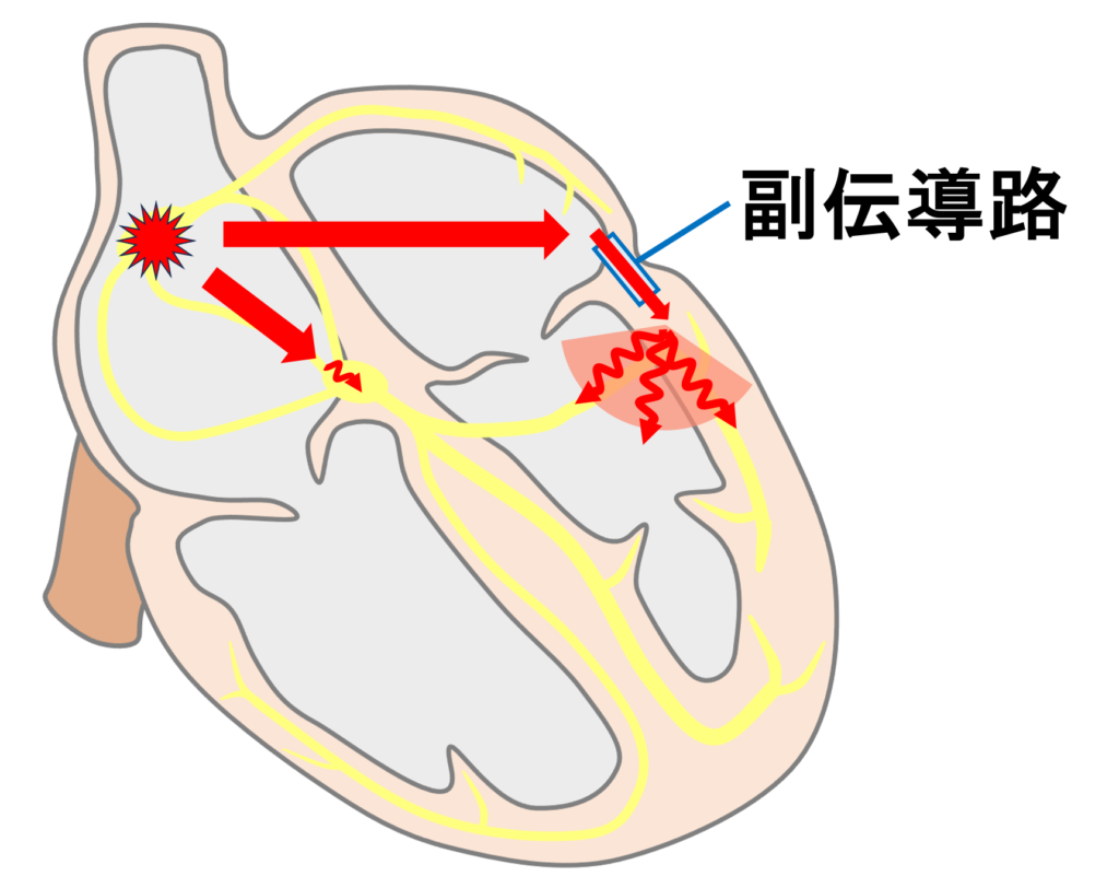 Δ波(delta wave)