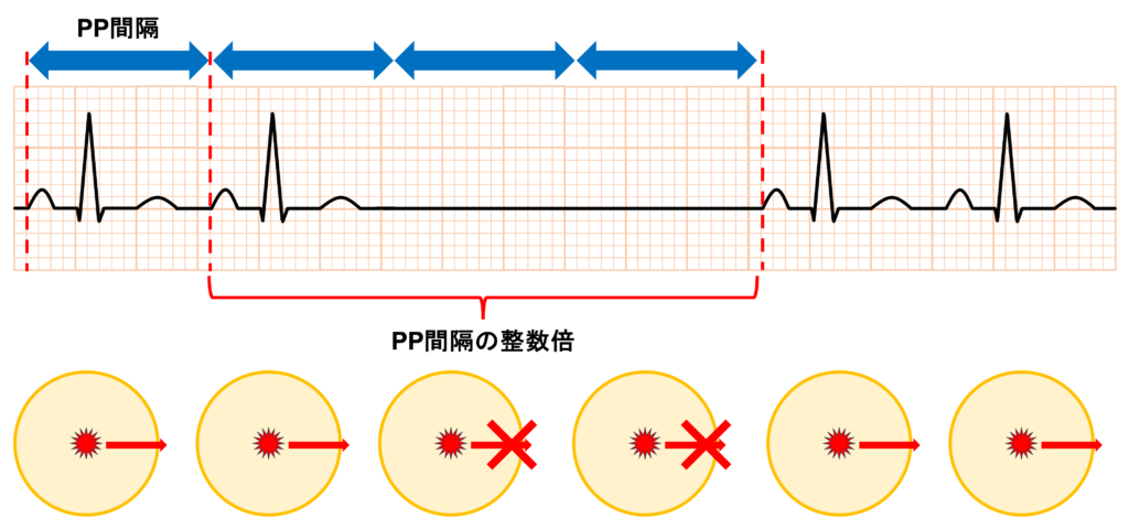 洞房ブロック(sinoatrial block)