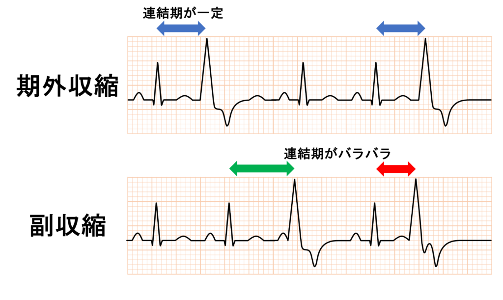 副収縮(Parasystole)