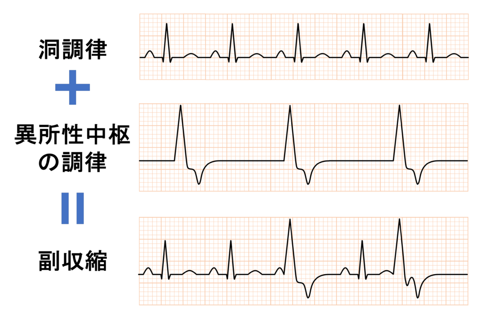 副収縮(Parasystole)