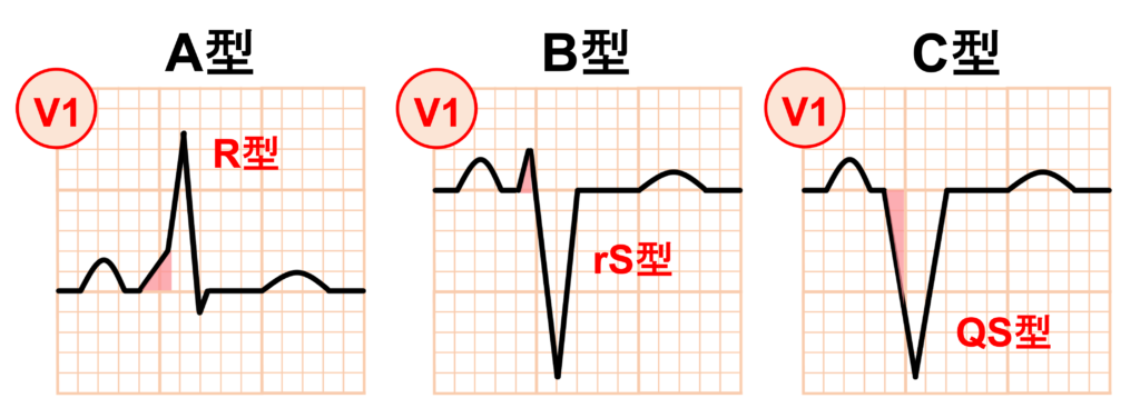 Δ波(delta wave)