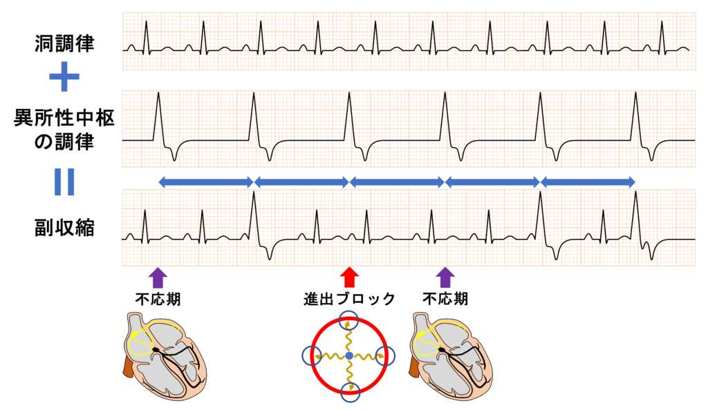 副収縮(Parasystole)