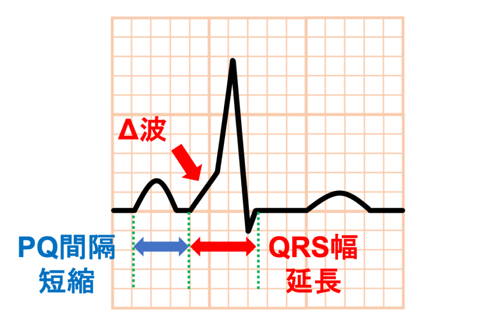 WPW症候群(Wolff-Parkinson-White syndrome)