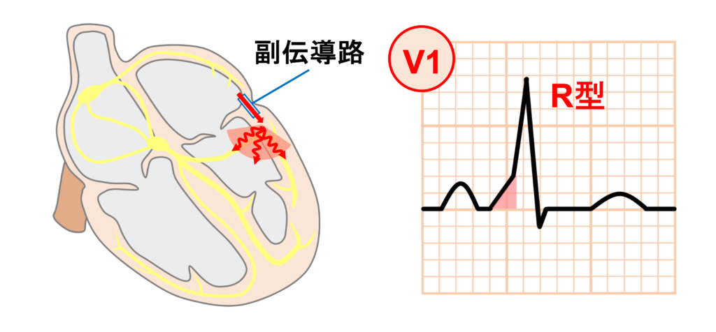 WPW症候群(Wolff-Parkinson-White syndrome)