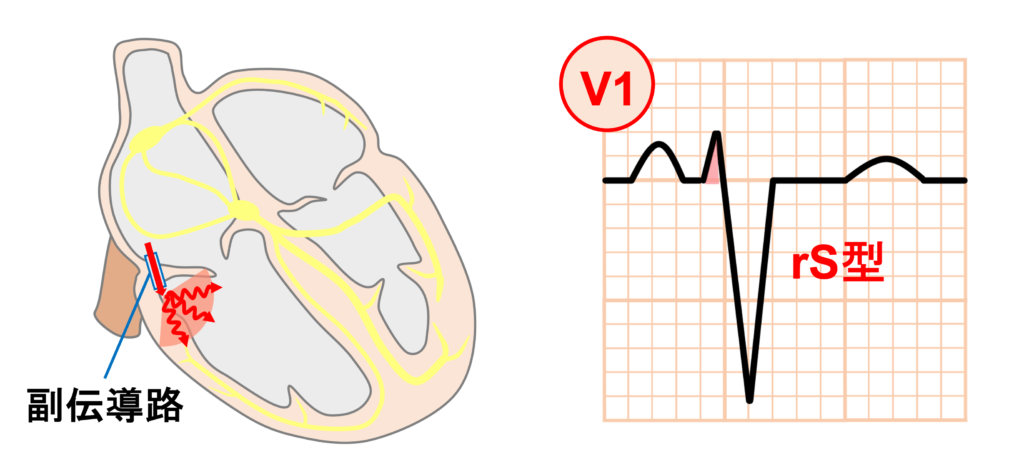 WPW症候群(Wolff-Parkinson-White syndrome)