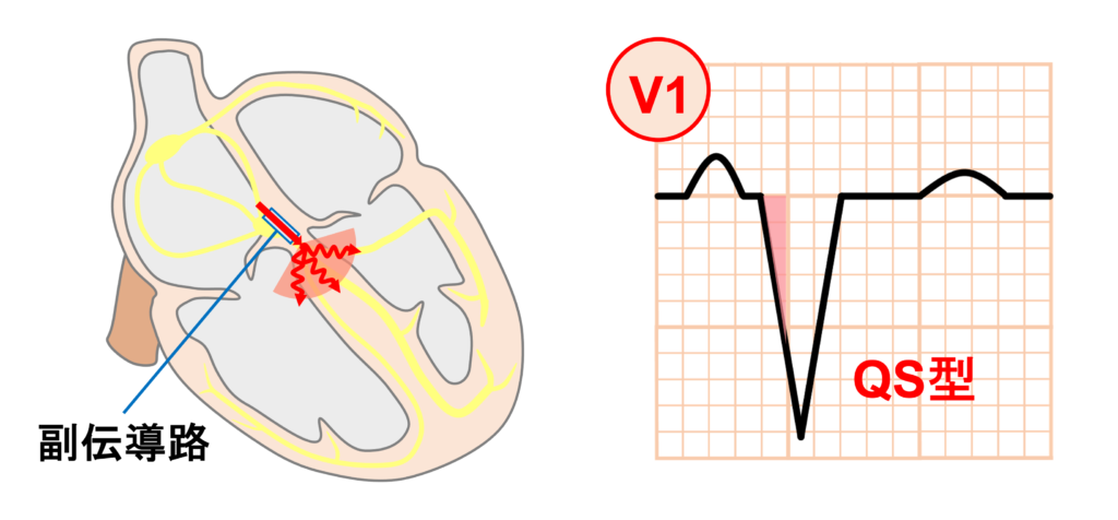 WPW症候群(Wolff-Parkinson-White syndrome)