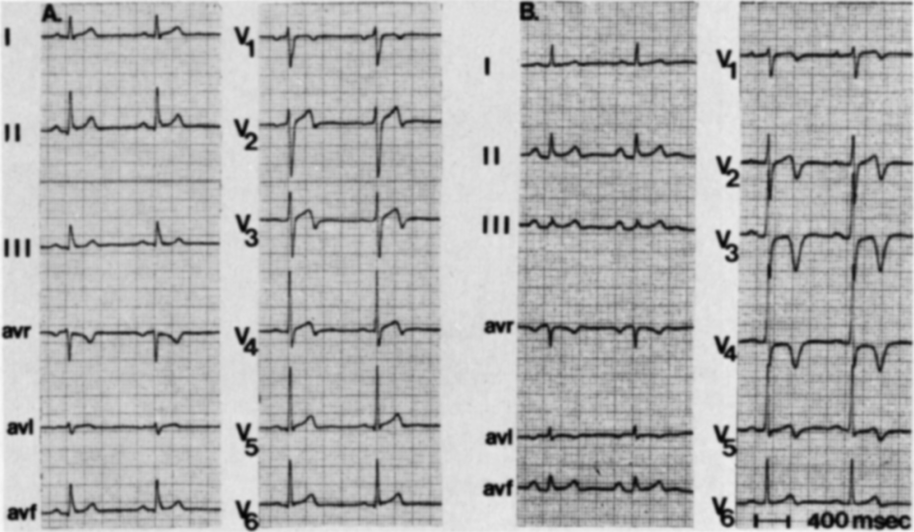 Wellens症候群(Wellens syndrome)