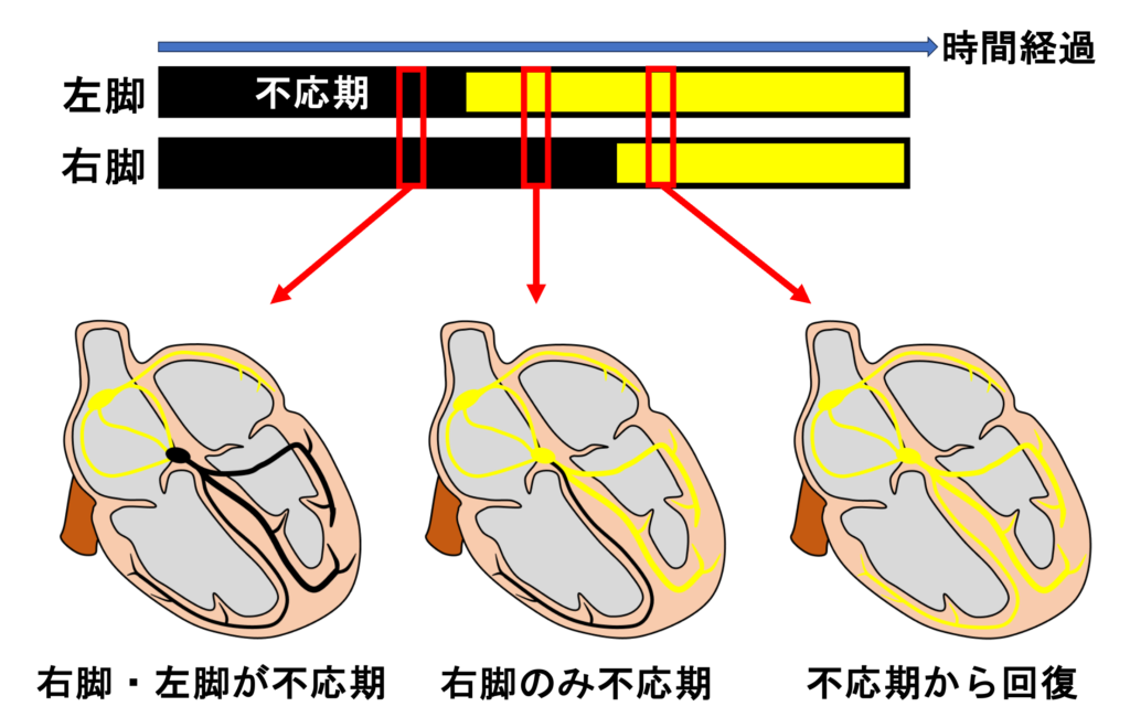 心室内変行伝導(aberrant intraventricular conduction)