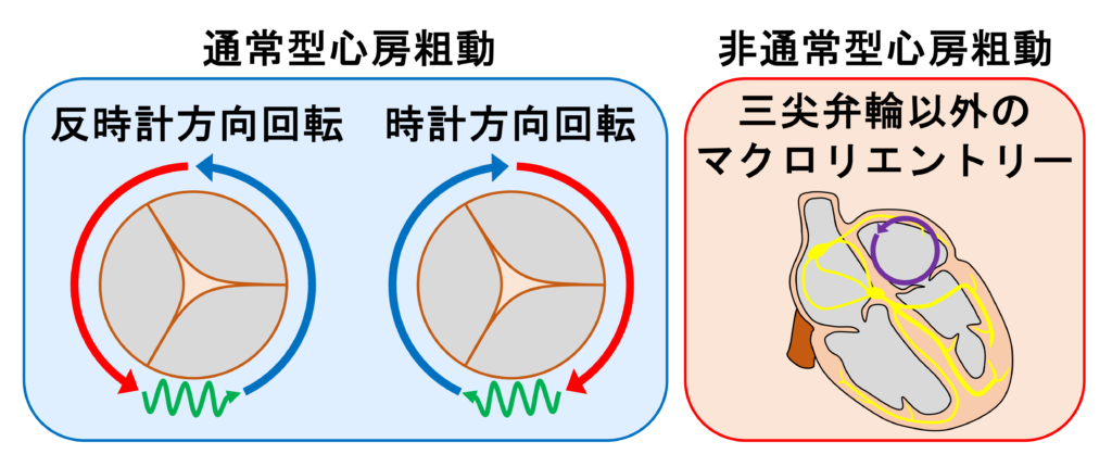 心房粗動(Atrial flutter)