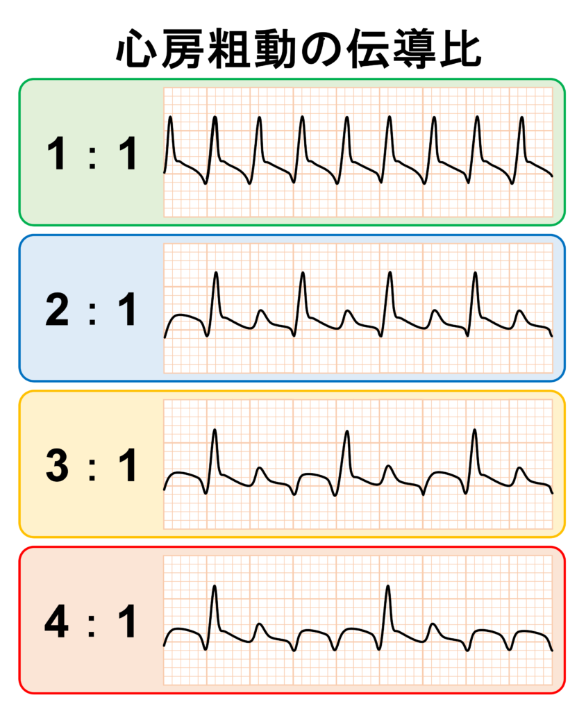 心房粗動(Atrial flutter)