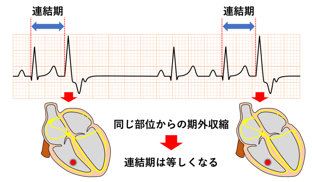 連結期(coupling interval)
連結期が一定であることを固定連結期(fixed coupling)、変動するもの移動連結性(variable coupling)と表現することがあります。期外収縮は一般的には先行する興奮に関連して発生するため、同一部位からの期外収縮であれば基本的に連結期は一定(固定連結期)であり、波形も同じ形になります。連結期が異なる場合(移動連結性)は複数部位からの期外収縮や副収縮を疑う必要があります。厳密には副収縮の場合には連結期という表現は用いないとする報告もあります