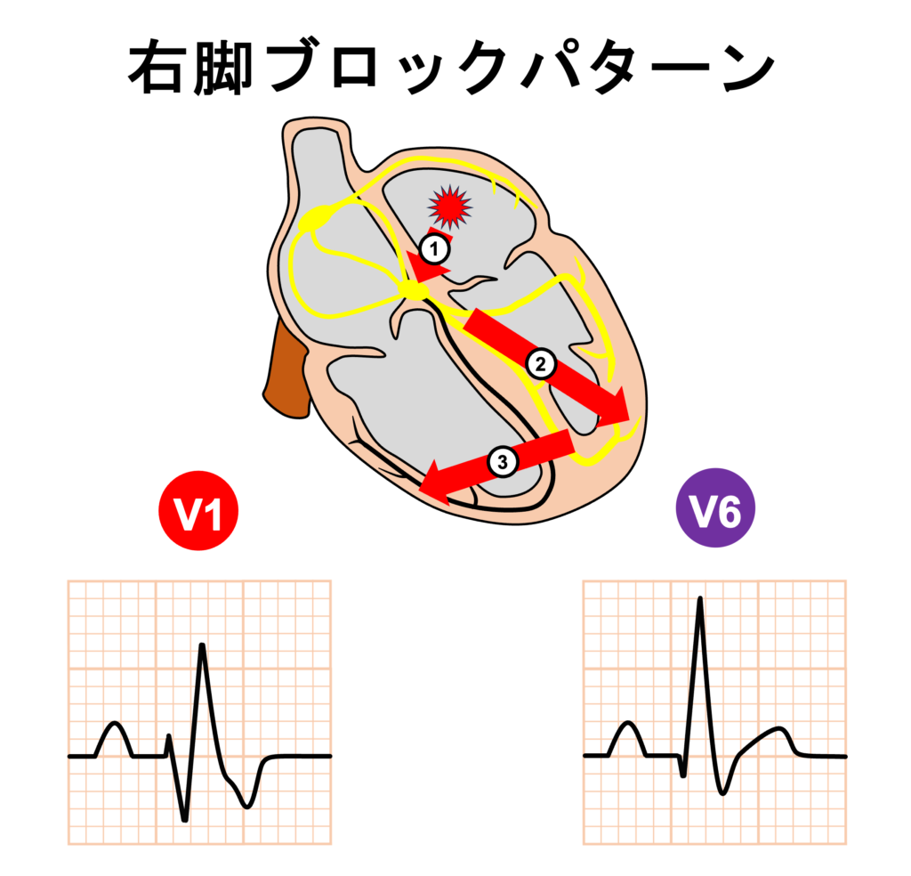 心室内変行伝導(aberrant intraventricular conduction)