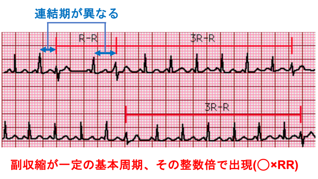 副収縮(Parasystole)