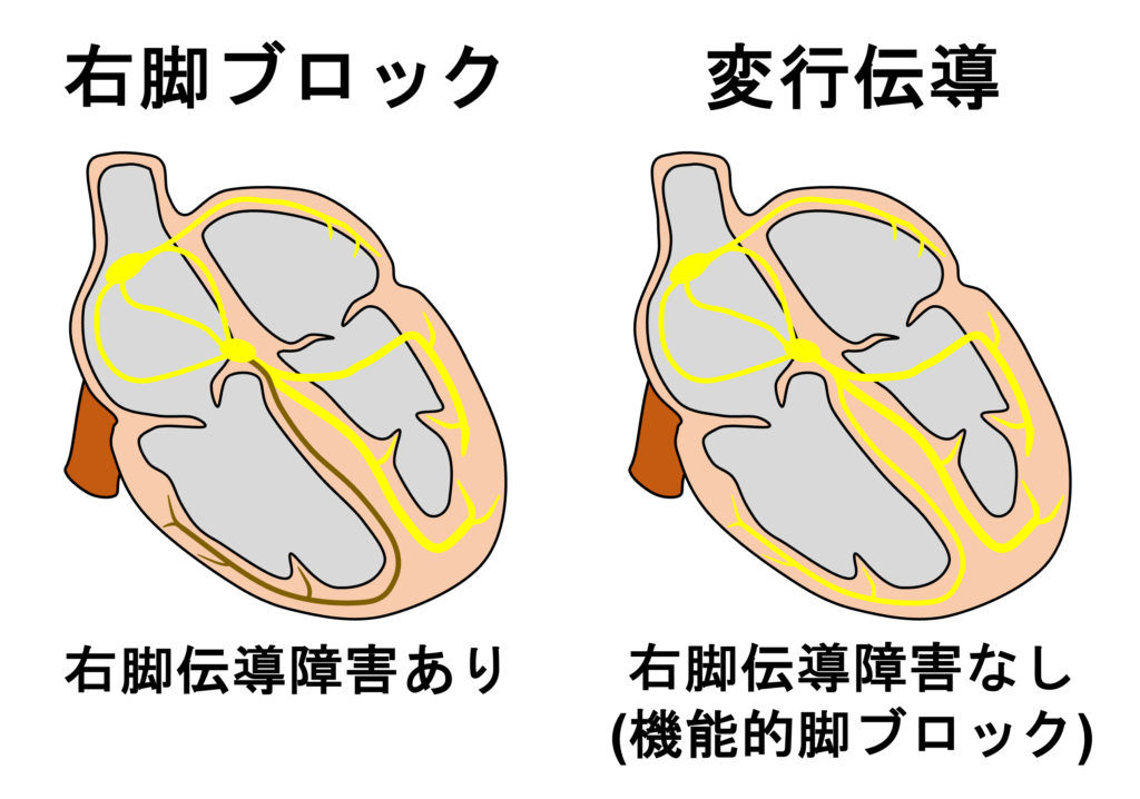 心室内変行伝導(aberrant intraventricular conduction)