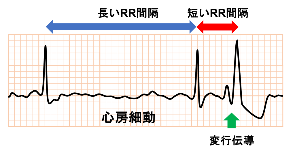 Ashman現象(Ashman phenomenon)