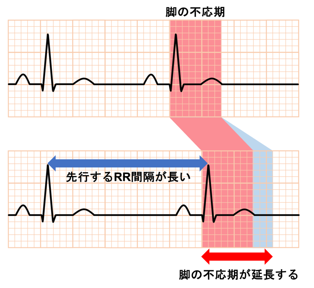 Ashman現象(Ashman phenomenon)