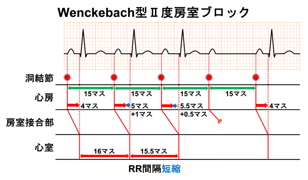 Wenckebach型Ⅱ度房室ブロック(Wenckebach second degree atrioventricular block)