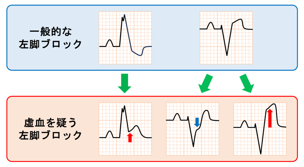 Sgarbossa's criteria