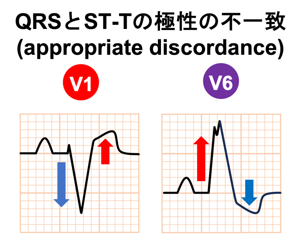 左脚ブロック(left bundle branch block)