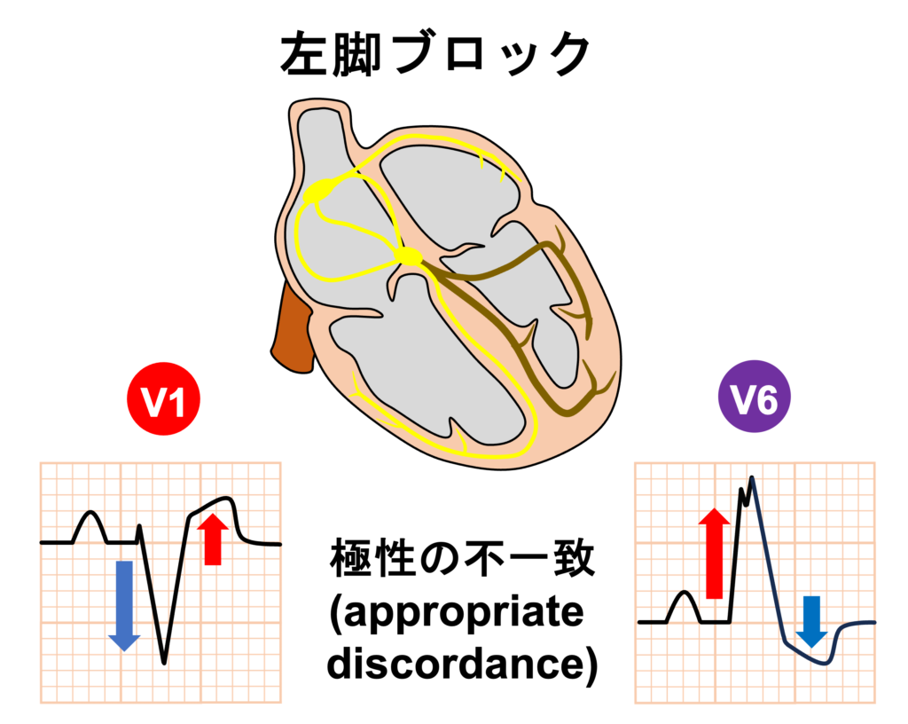 Sgarbossa's criteria