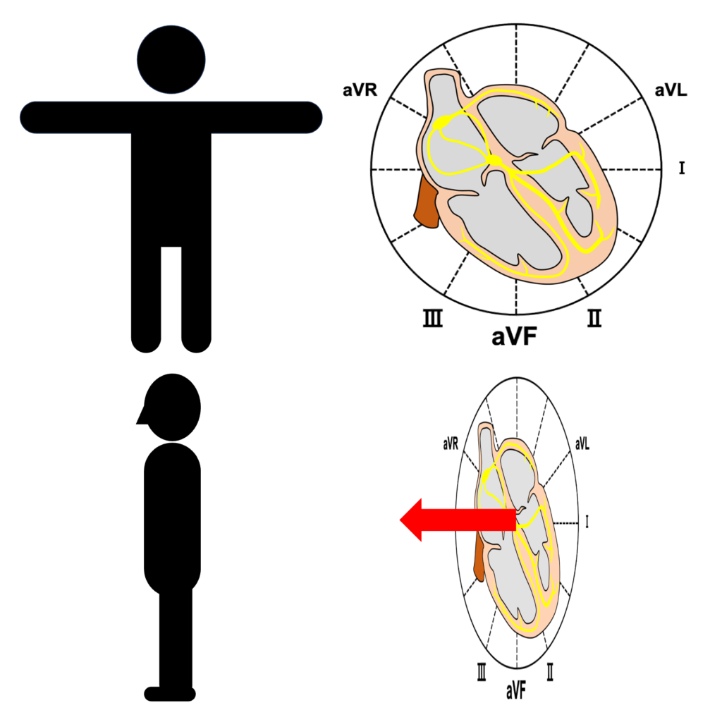 不定軸(indeterminate axis)