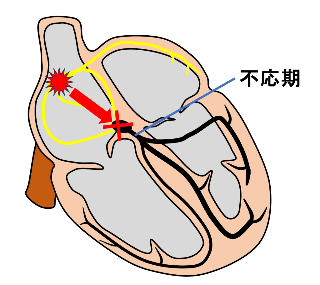 不応期(refractory period)