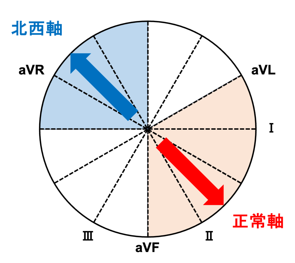 北西軸(northwest QRS axis)