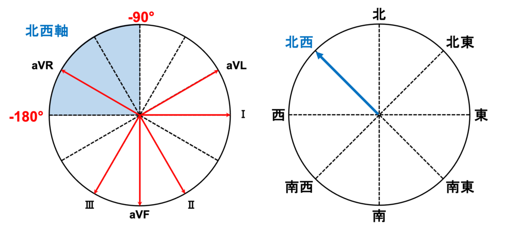 北西軸(northwest QRS axis)