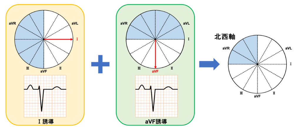 北西軸(northwest QRS axis)