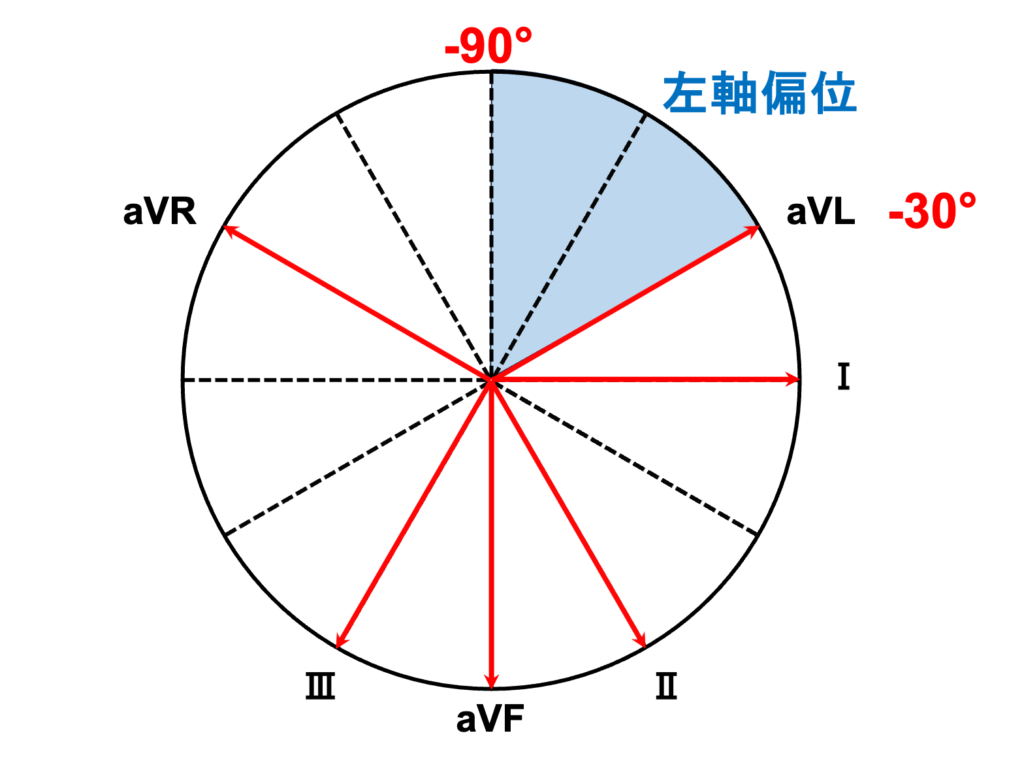 左軸偏位(left axis deviation)