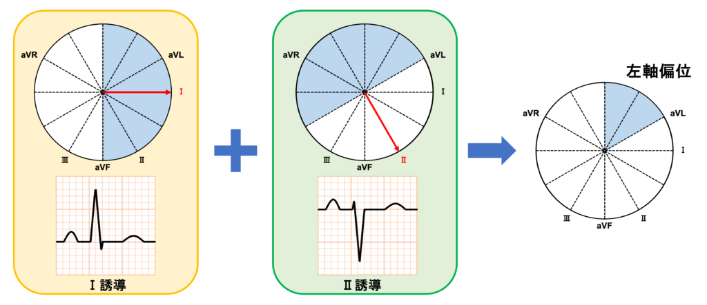 左軸偏位(left axis deviation)