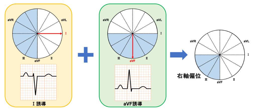 右軸偏位(right axis deviation)