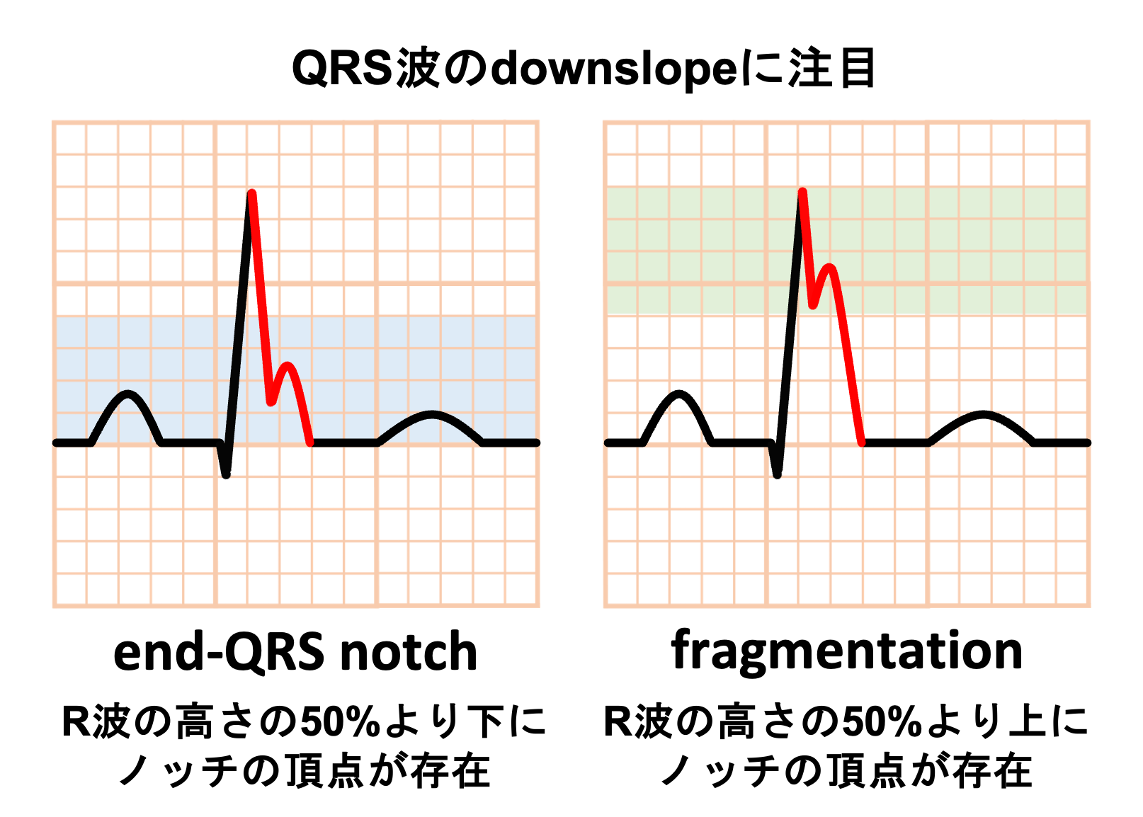 早期脱分極 – 早期脱分極 心電図 _ 早期再分極異常症候群 再分極異常vs.脱分極異常 – INRO