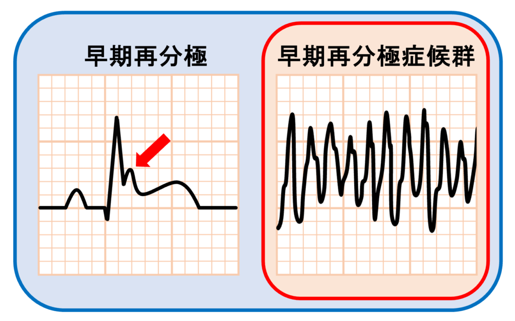 早期再分極(early repolarization)