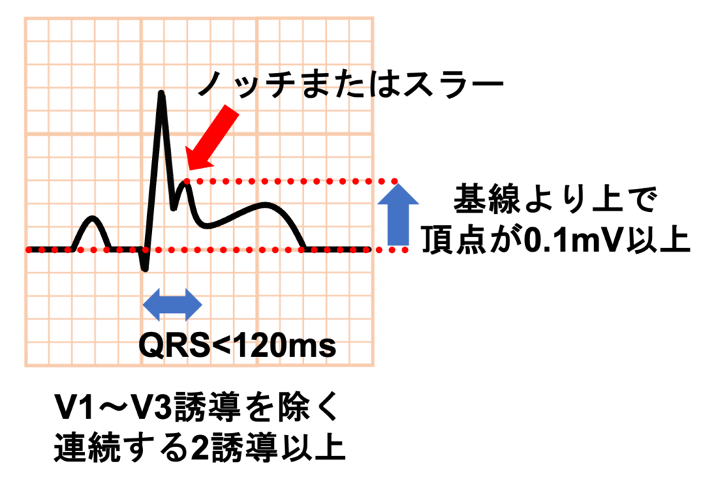 早期再分極(early repolarization)