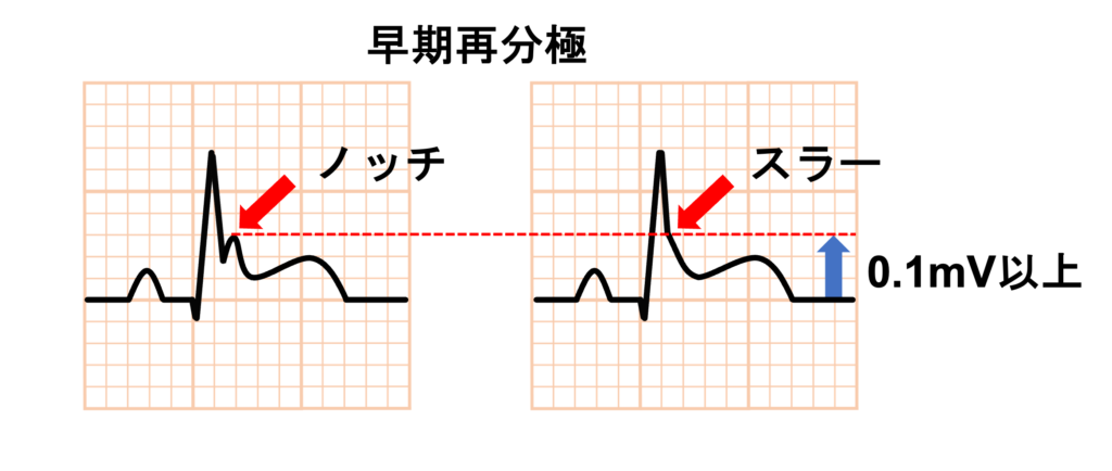 極は隣接する2つの誘導に0.1mV以上のJ点上昇がみられ、スラー状またはノッチ状の形態が認められる場合に定義されます。