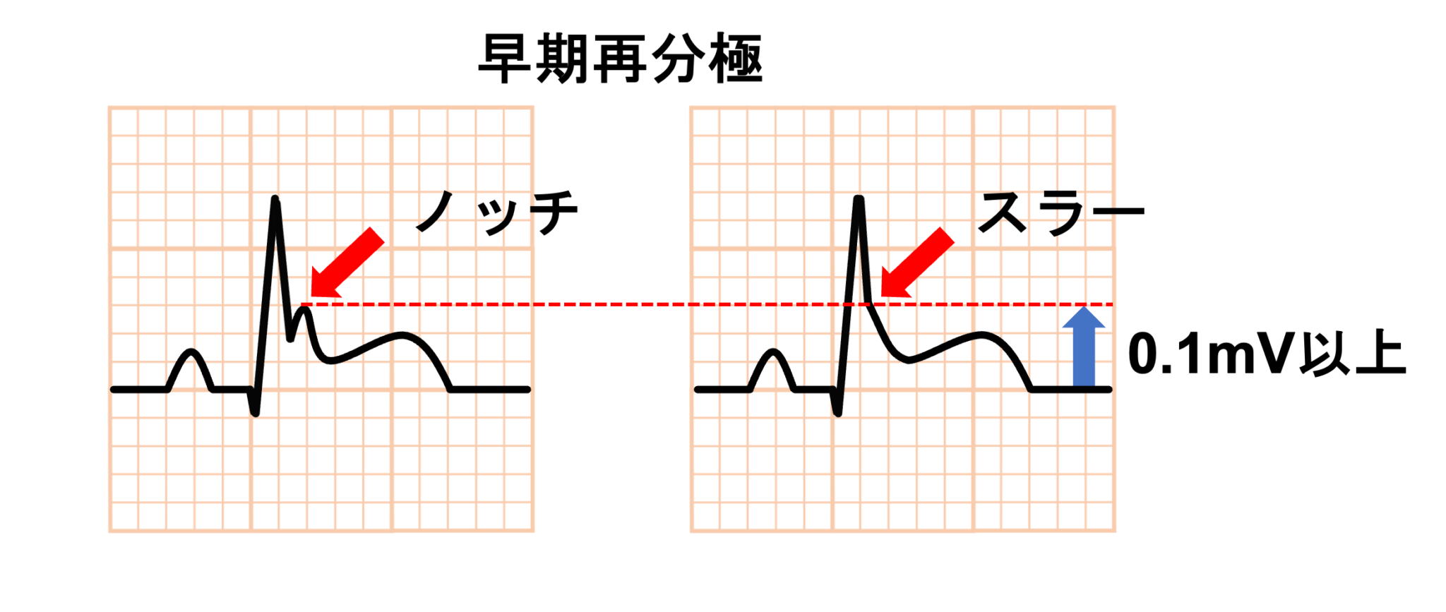 早期再分極症候群とは? | 心電図.com
