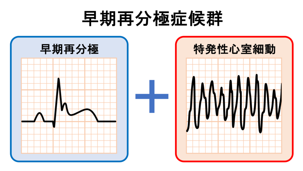 早期再分極症候群(early repolarization syndrome)