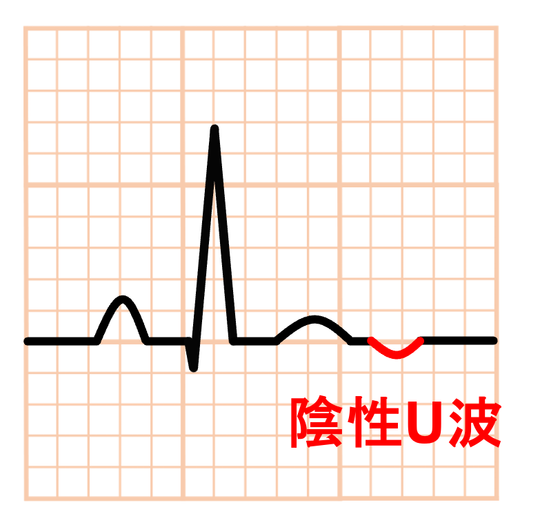 陰性U波(negative U wave)