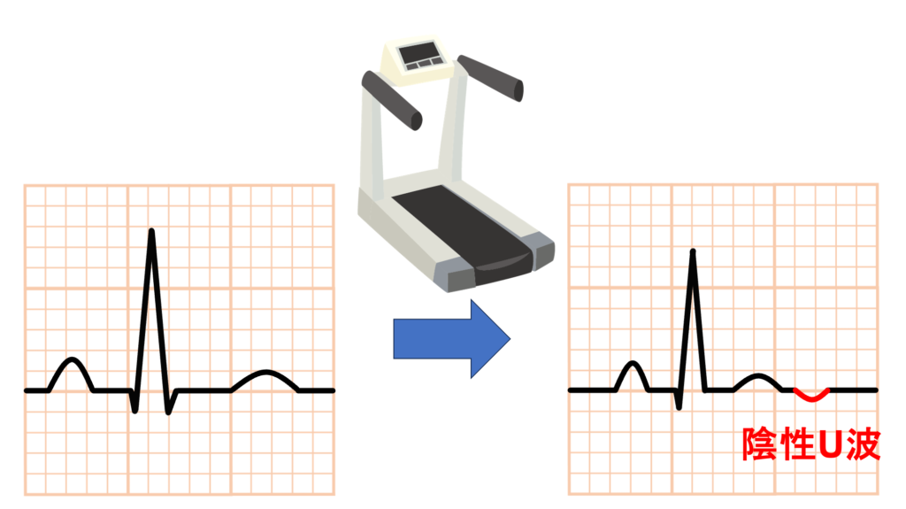 陰性U波(negative U wave)