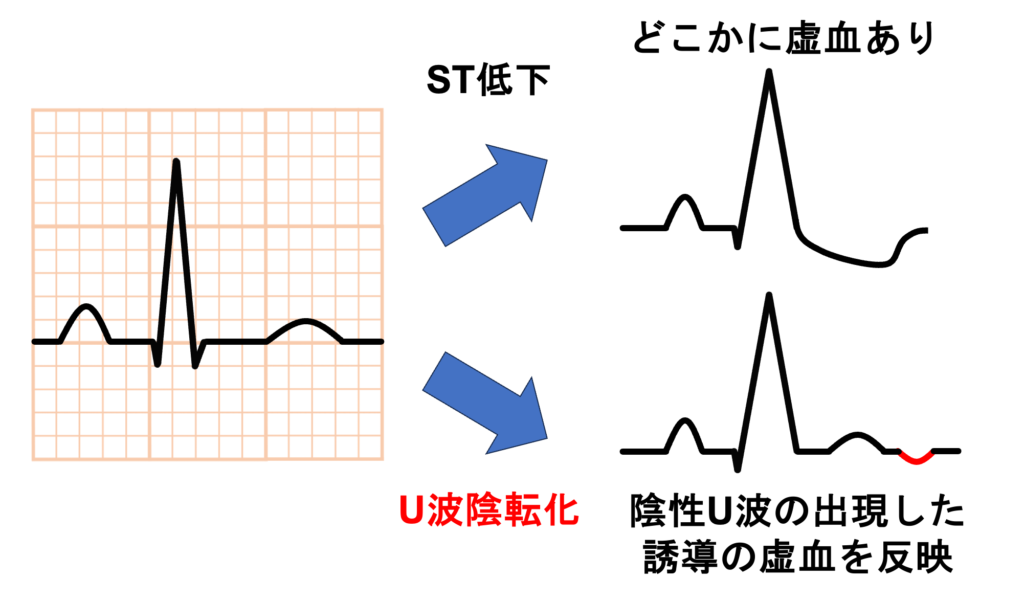 陰性U波(negative U wave)