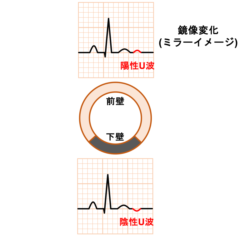 陰性U波(negative U wave)