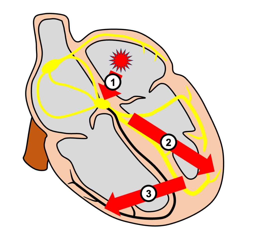 心室内変行伝導(aberrant intraventricular conduction)