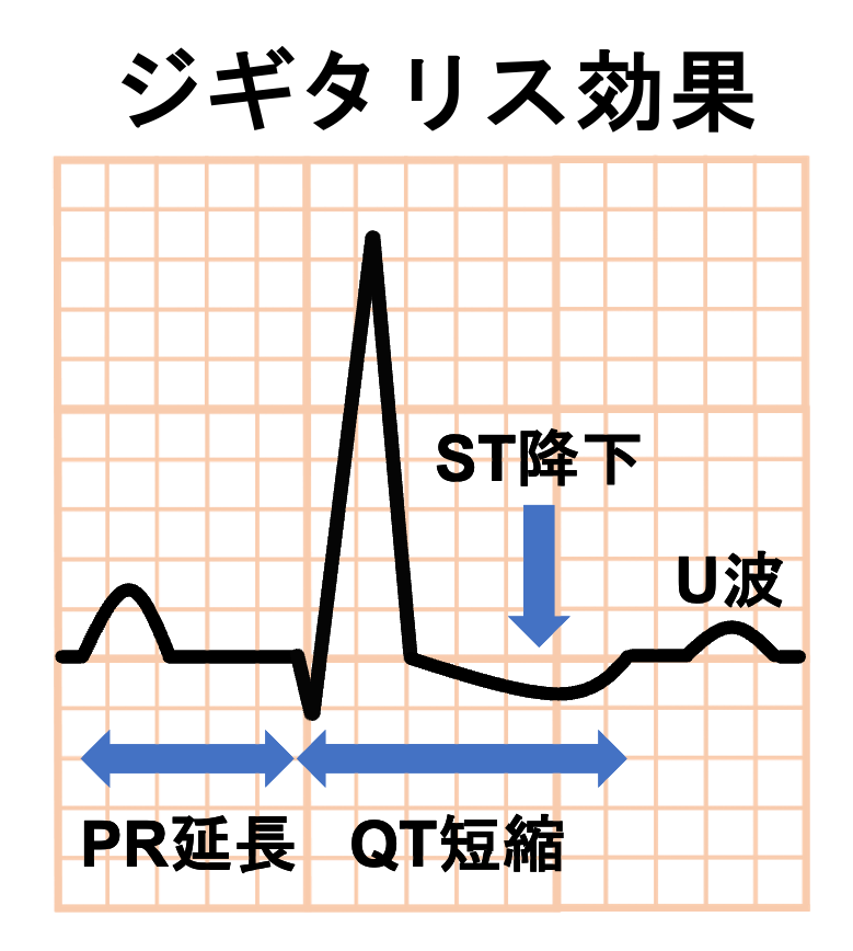 ジギタリス効果(digitalis effect)