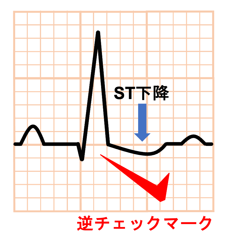 ジギタリス効果(digitalis effect)