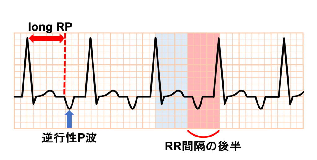 fast-slow AVNRTとは？ | 心電図.com