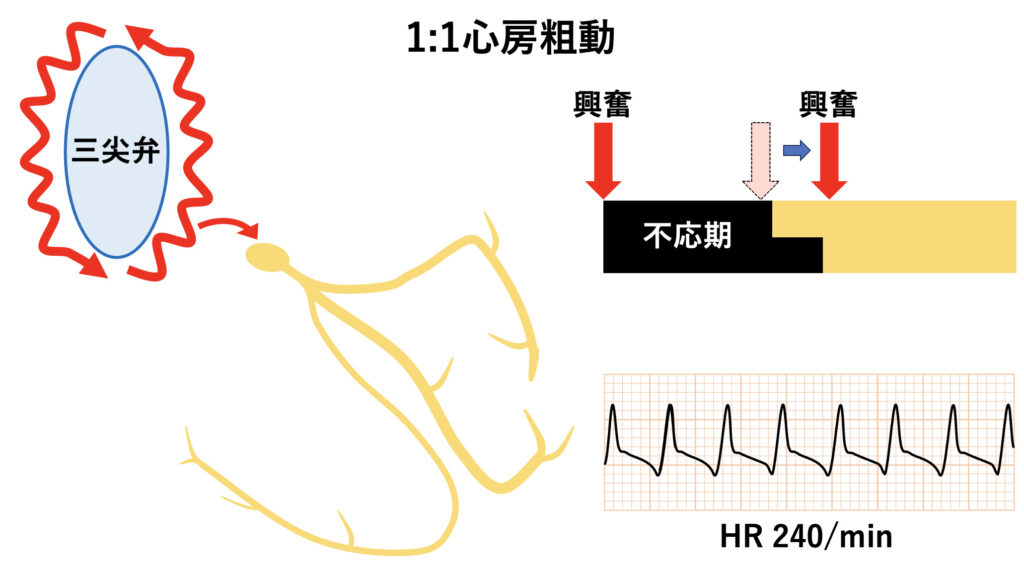 Ⅰc flutter