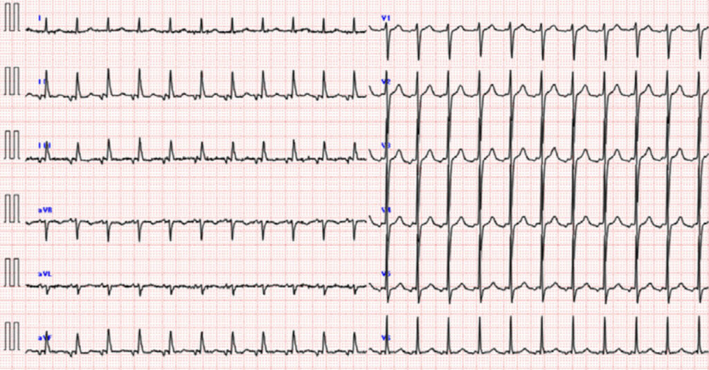 ATP感受性心房頻拍(ATP-sensitive atrial tachycardia)